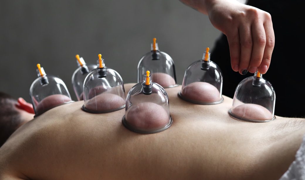 Wichita Cupping Therapy Treatment